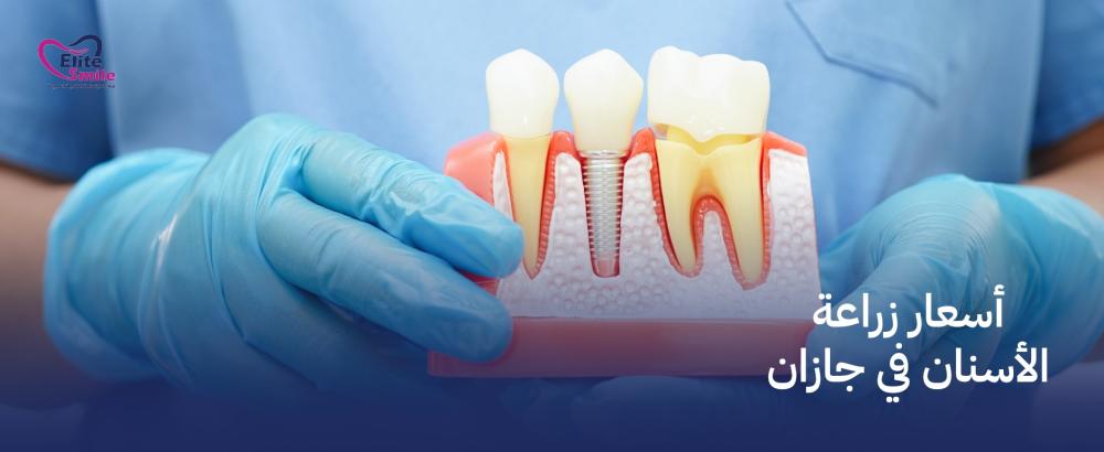 أسعار زراعة الأسنان في جازان