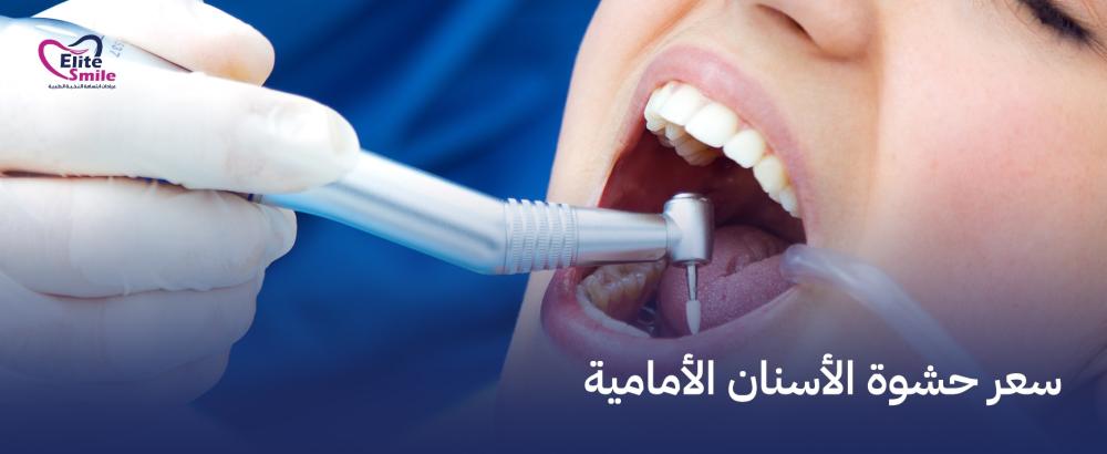 سعر حشوة الأسنان الأمامية