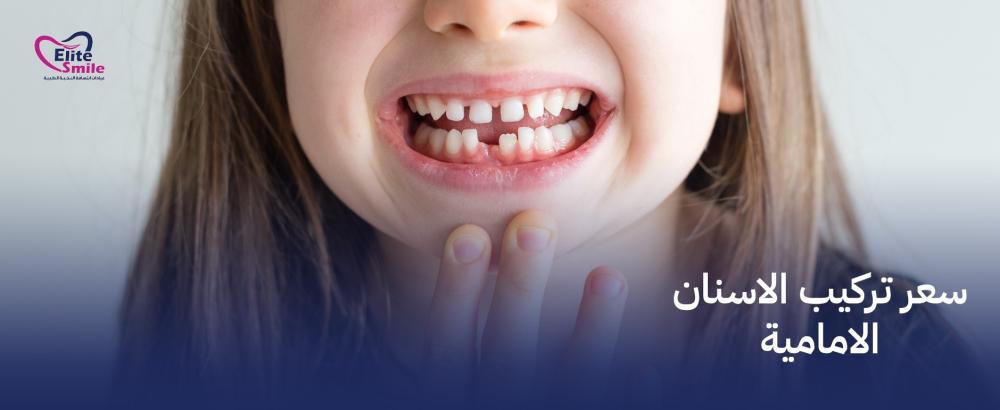 سعر تركيب الاسنان الامامية