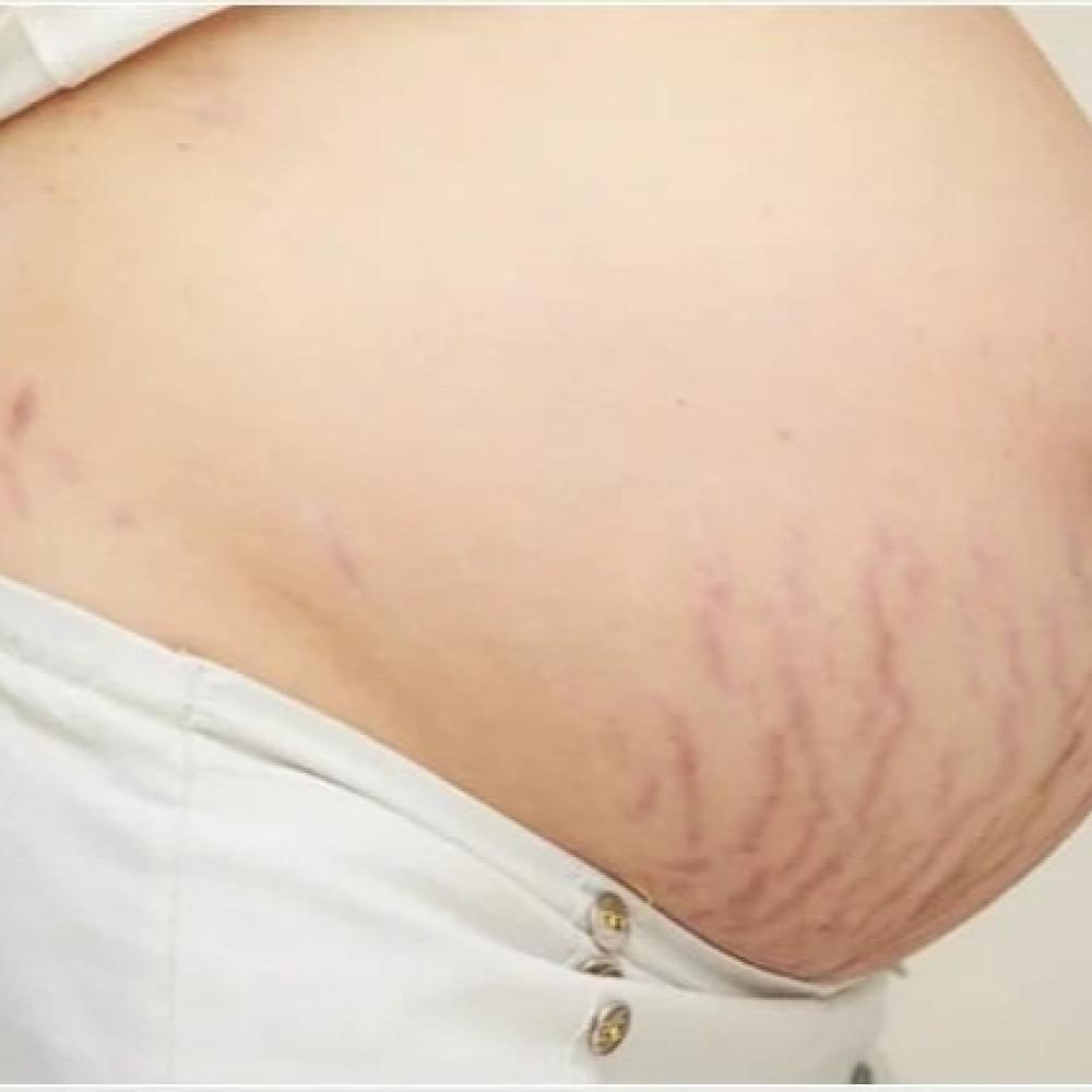 هل الليزر المنزلي يعالج آثار التمدد نهائيًا