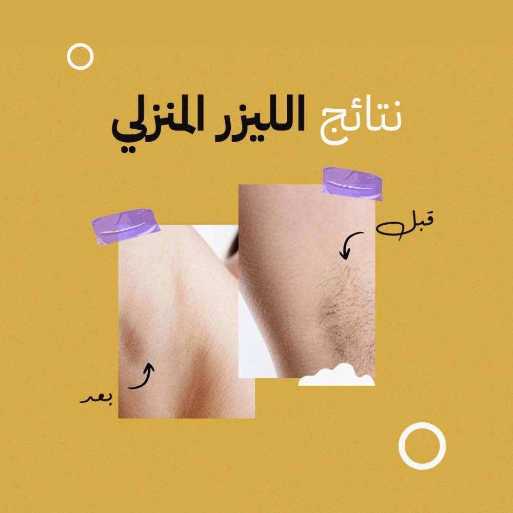 نتائج إزالة الشعر بالليزر