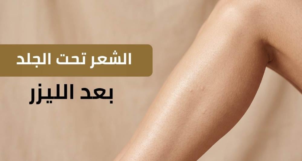 الشعر تحت الجلد بعد الليزر