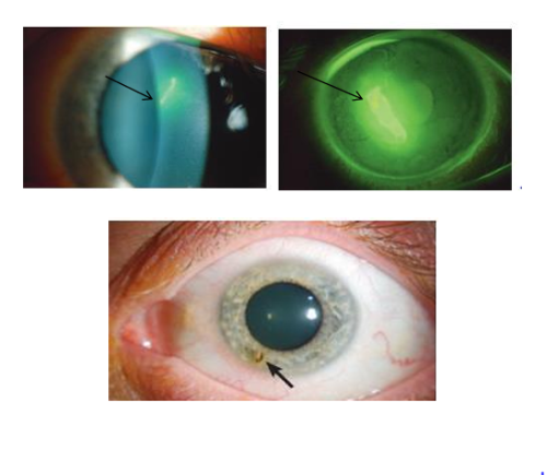 خدش القرنية corneal abrasion