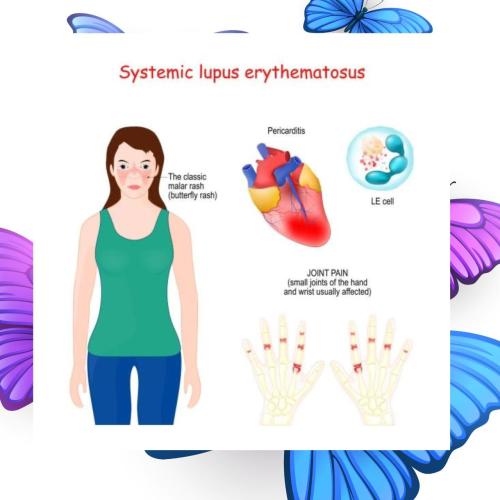 Systemic Lupus Erythematous