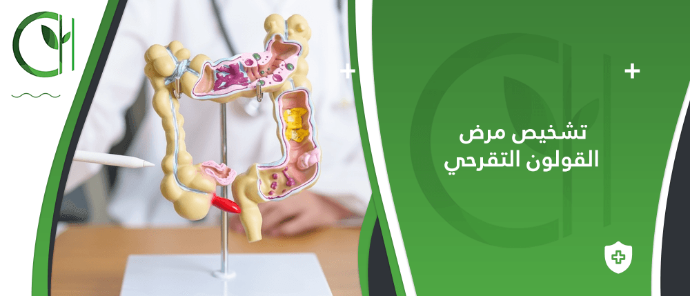 كيف يتم تشخيص مرض القولون التقرحي؟