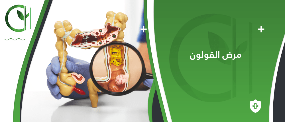 ما هي أعراض مرض القولون الأكثر شيوعاً؟