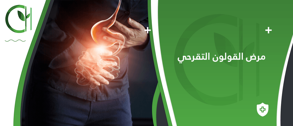 ما هي النصائح للتعامل مع نوبات مرض القولون التقرحي؟