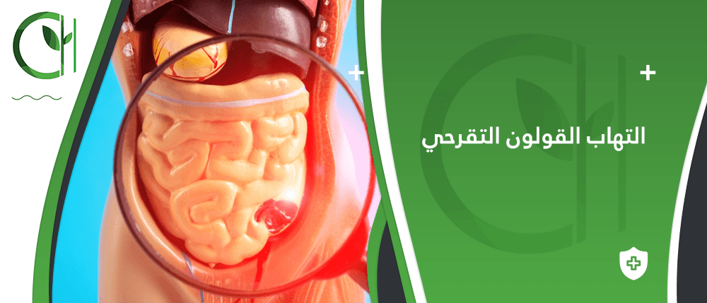 كيف اعرف اني مصاب بالتهاب القولون التقرحي؟