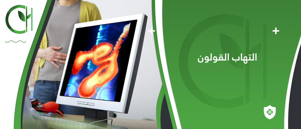 هل هناك طرق لمنع التهاب القولون التقرحي؟