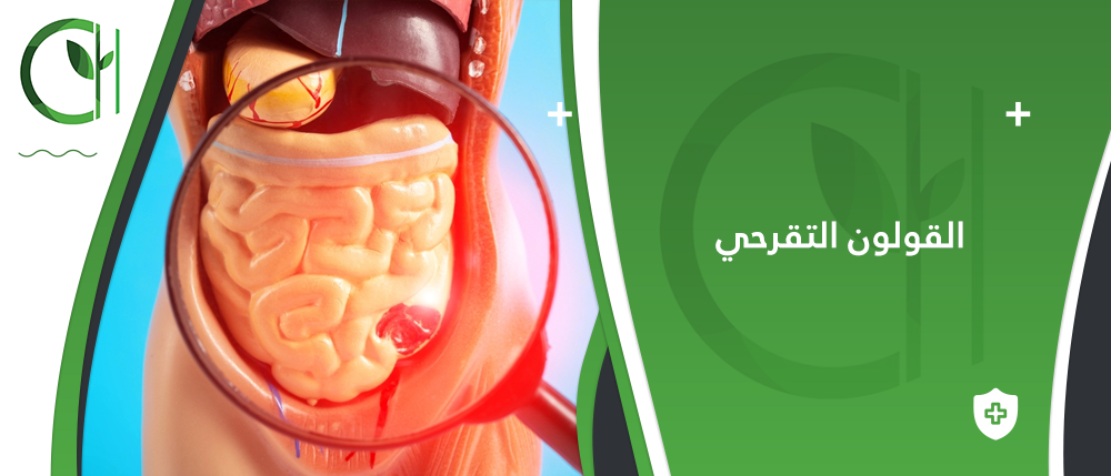 كيفية التعامل مع القولون التقرحي: نصائح فعالة لتخفيف الأعراض