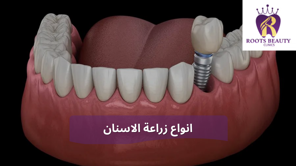 انواع زراعة الاسنان