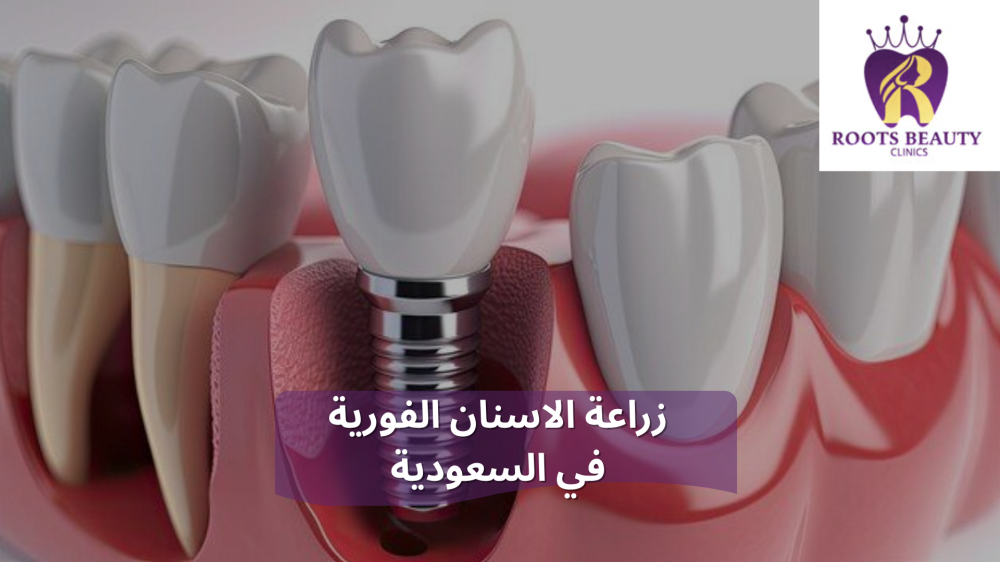زراعة الاسنان الفورية في السعودية