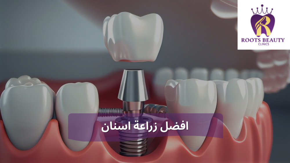 افضل زراعة اسنان