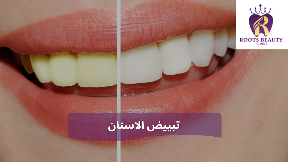 تبييض الاسنان