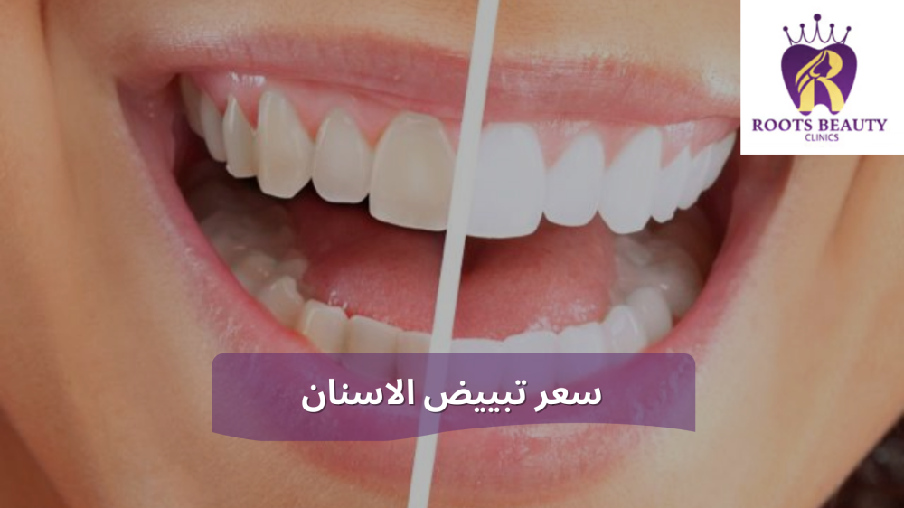 سعر تبييض الاسنان