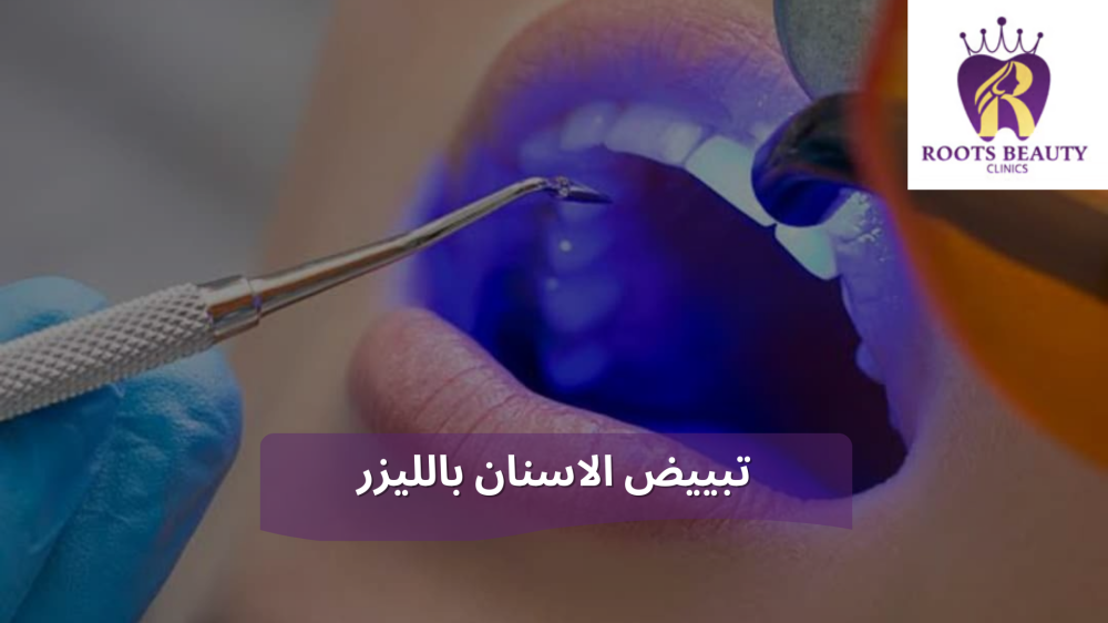 تبييض الاسنان بالليزر