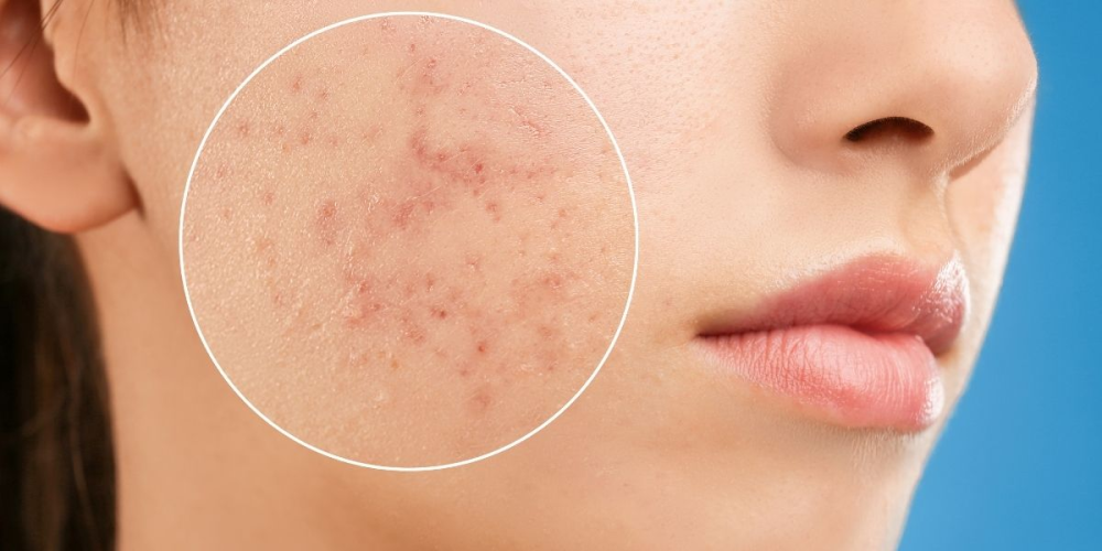 أفضل الطرق للتخلص من آثار الحبوب