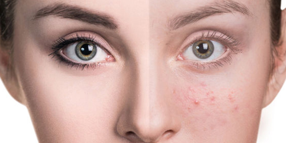 اكتشفي أفضل طرق علاج حب الشباب بفعالية، من العناية اليومية إلى المكونا