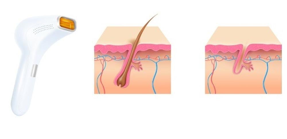 ليزر إزالة الشعر للنساء: الأداة السحرية لجسم أكثر نعومة