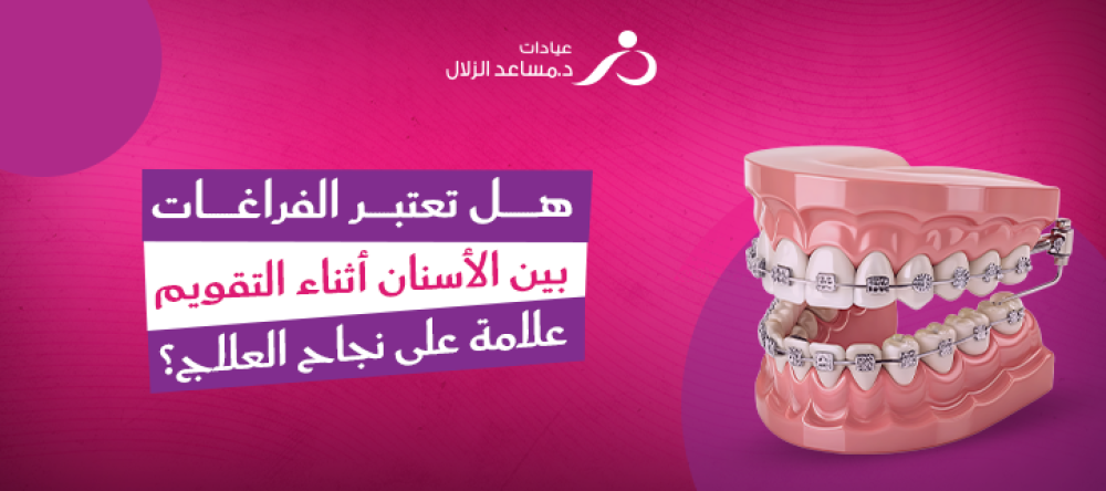 هل تعتبر الفراغات بين الأسنان أثناء التقويم علامة على نجاح العلاج؟