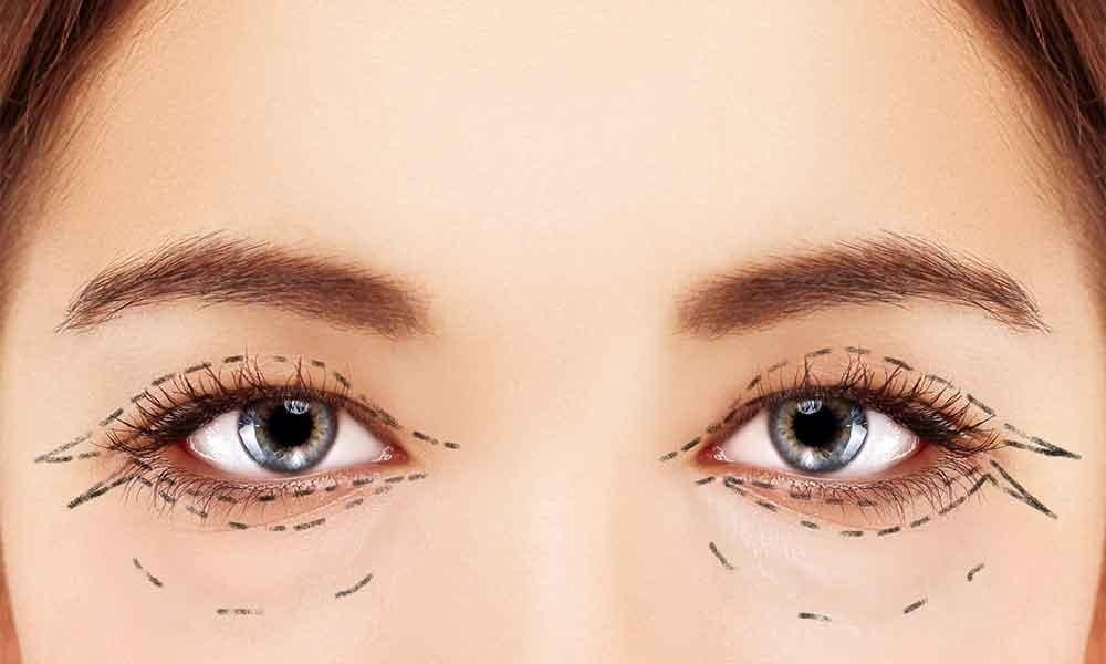 عملية شد الجفون