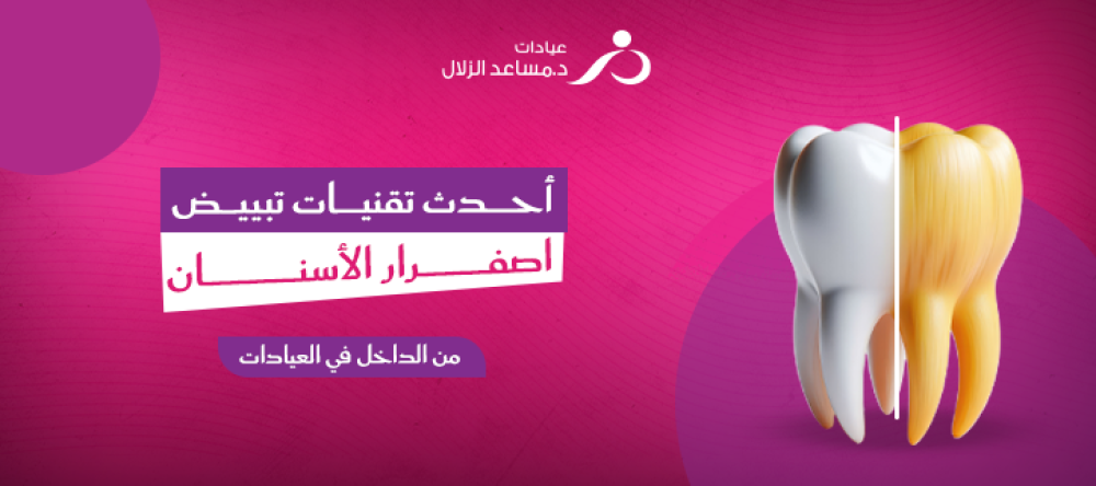 تبييض اصفرار الأسنان من الداخل