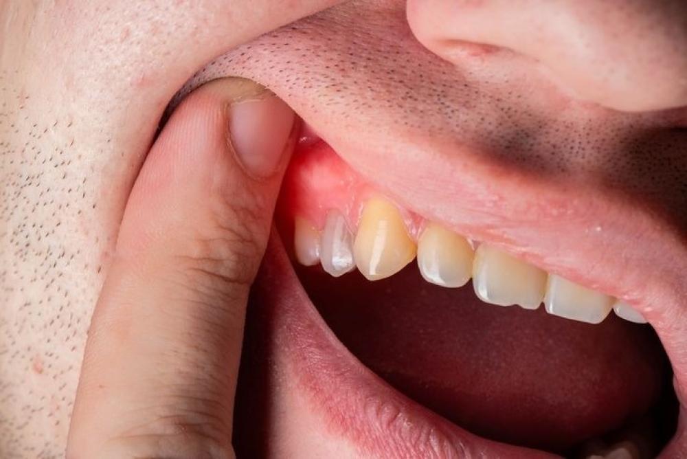 علاج التهاب اللثة سريع المفعول  حلول فعّالة تريحك من الألم فورًا