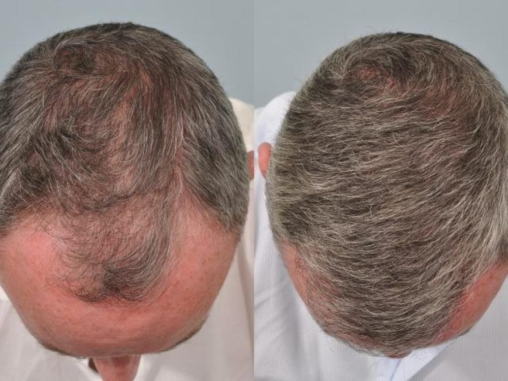 كم سنة تدوم زراعة الشعر