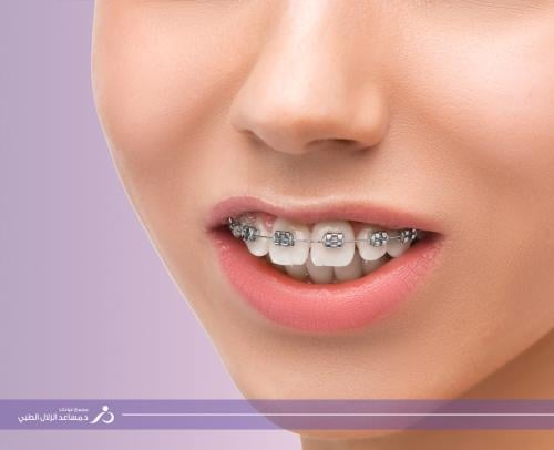 دفعه اولئ للتقويم الاسنان