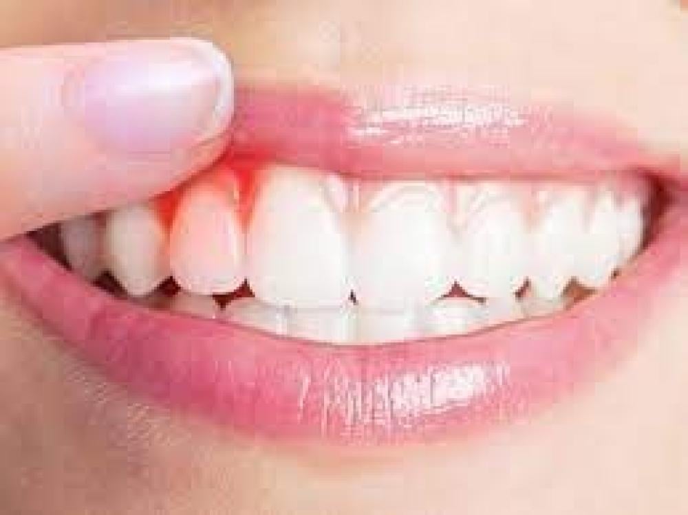 التهاب اللثة