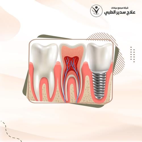 زراعة الأسنان السويسرية ROOTT شامل التركيبة