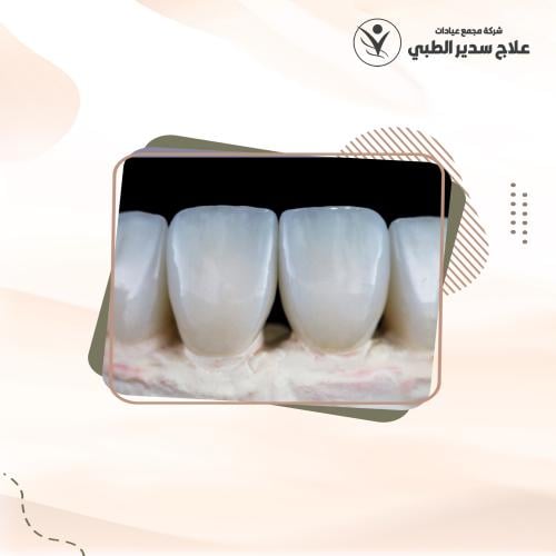 تركيبة ايماكس