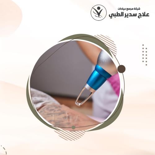 3 جلسات إزالة تاتو كبير