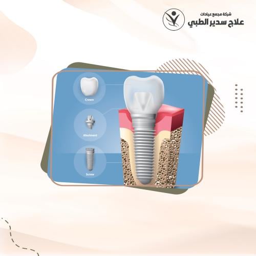 زراعة الاسنان الامريكية HIOSSEN شامل التركيبة