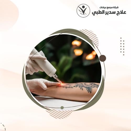 إزالة تاتو كبير