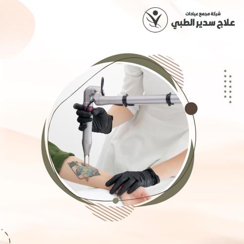 إزالة تاتو صغير
