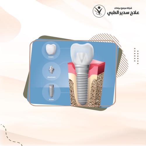 زراعة الاسنان الكوري Megagen شامل التركيبة