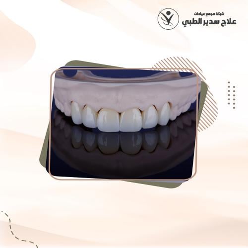 تركيبة البورسلين