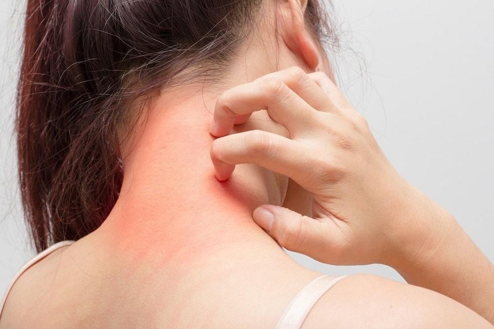 Eczema - everything you need to know about it and how to treat it
