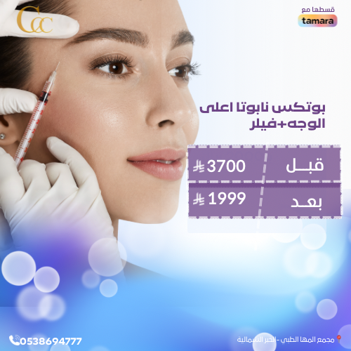 بوتكس  نابوتا اعلى الوجه +فيلر شفايف
