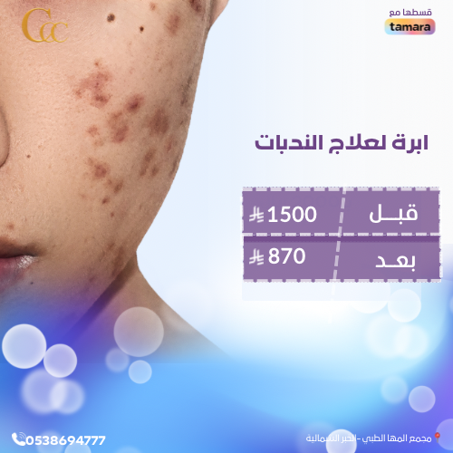 ابرة لعلاج الندبات