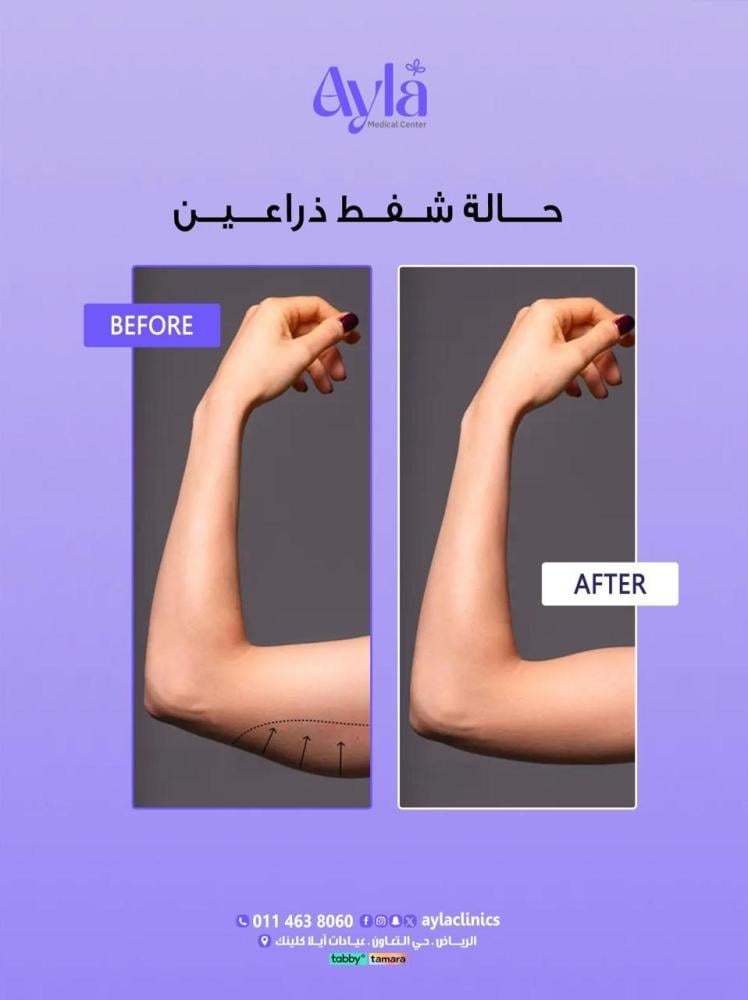 شفط دهون الذراعين