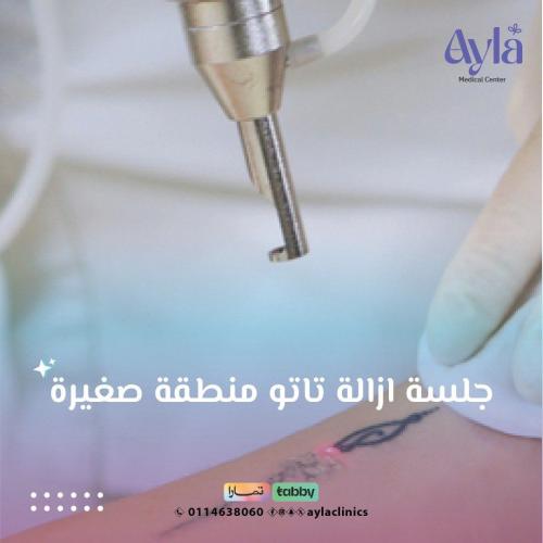 جلسة ازالة تاتو منطقة صغيرة