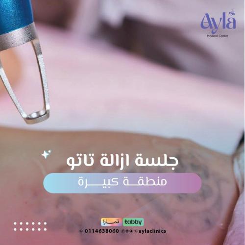 جلسة ازالة تاتو منطقة كبيرة