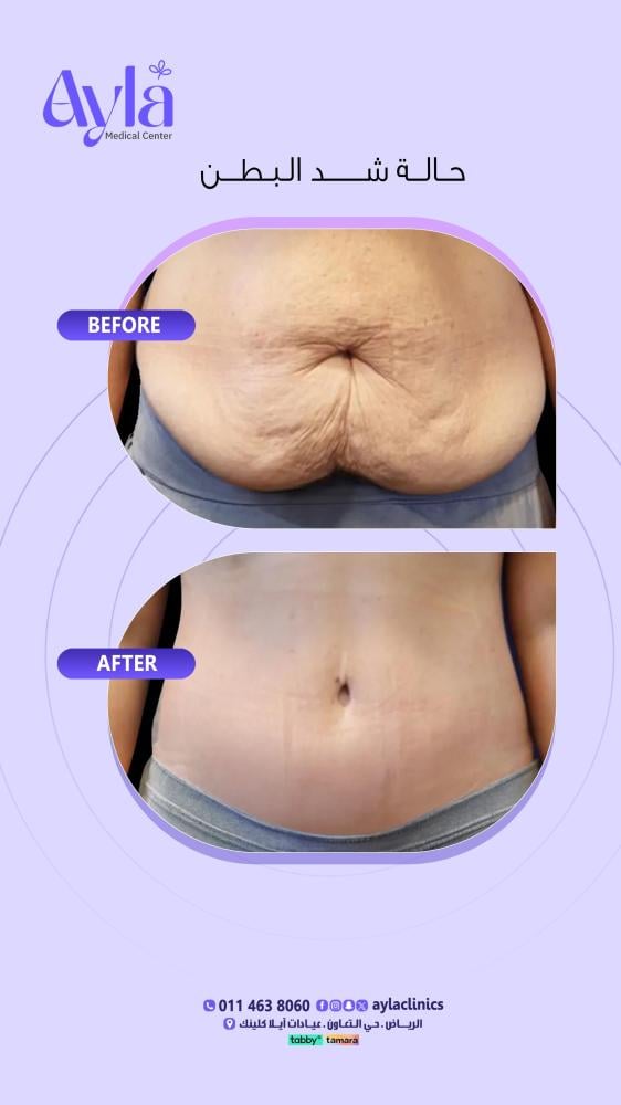 شد البطن الجراحي