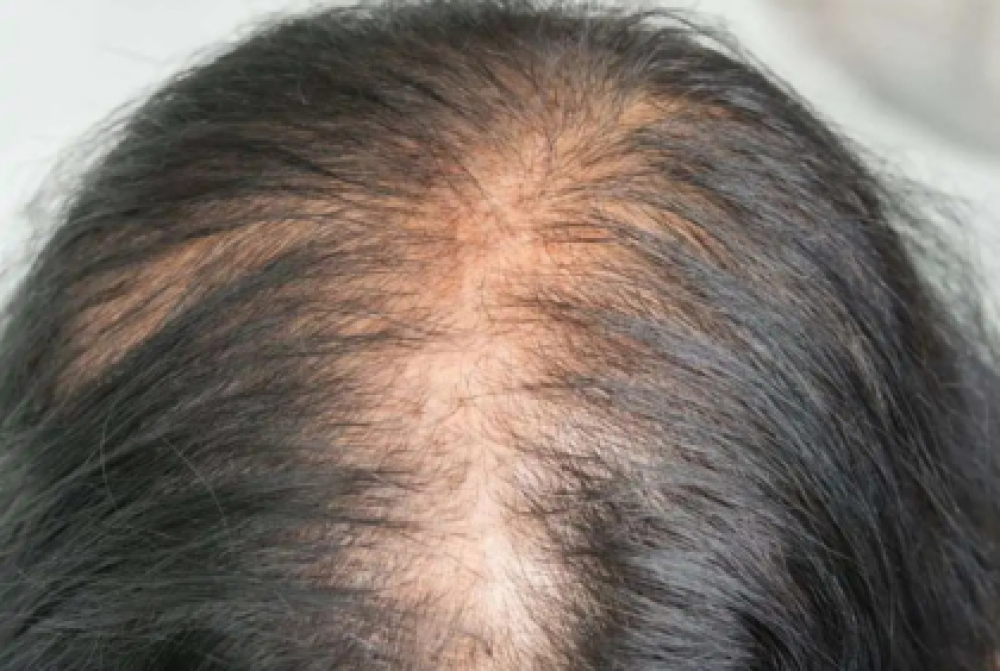 حلول احترافية لفراغات الشعر والشعر الخفيف في صالون خط الجمال بالرياض