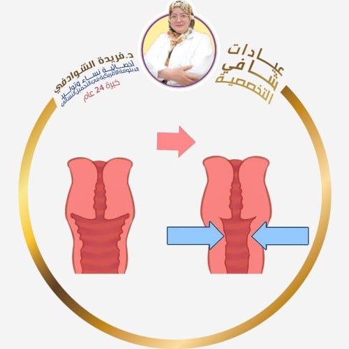 تضييق وترميم المهبل داخليا و خارجيا وشد العضلات ال...