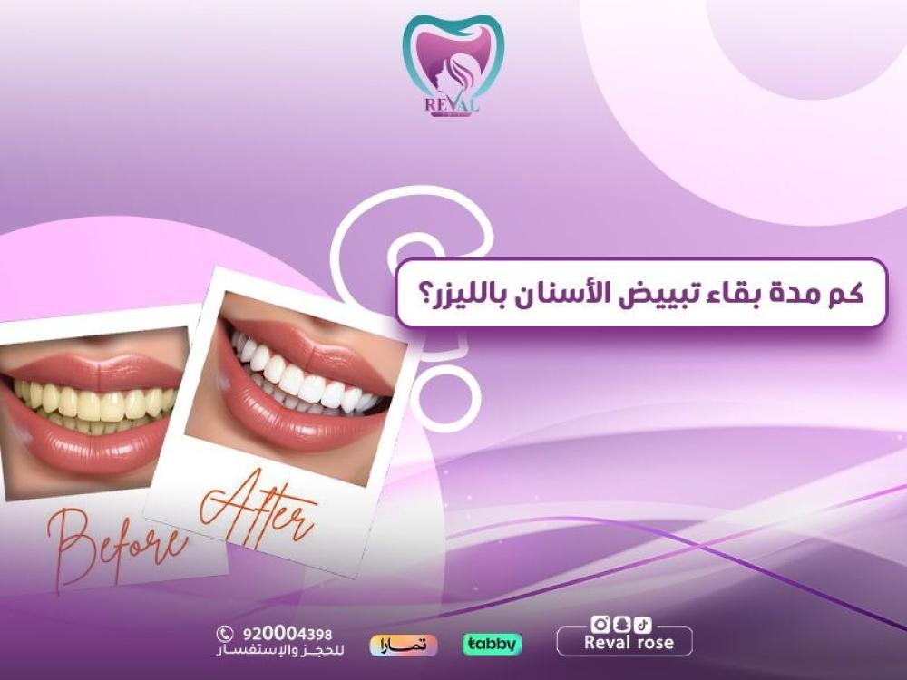 كم مدة بقاء تبييض الأسنان بالليزر