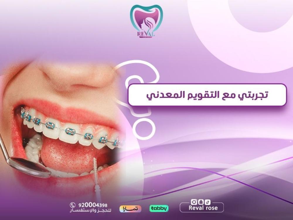 تجربتي مع التقويم المعدني: الحل الأمثل لتصحيح مشاكل أسنانك بشكل تدريجي