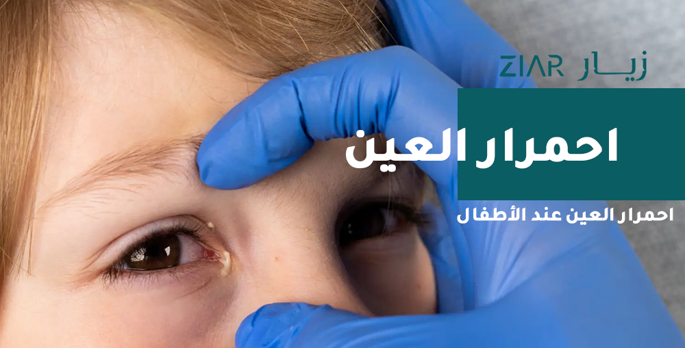 أسباب احمرار العين عند الأطفال